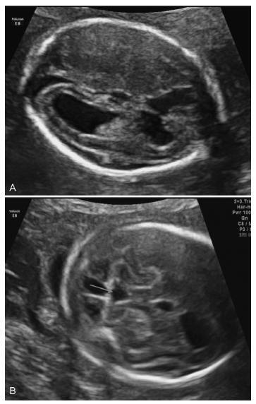 Nonprimary Cytomegalovirus Fetal Infection