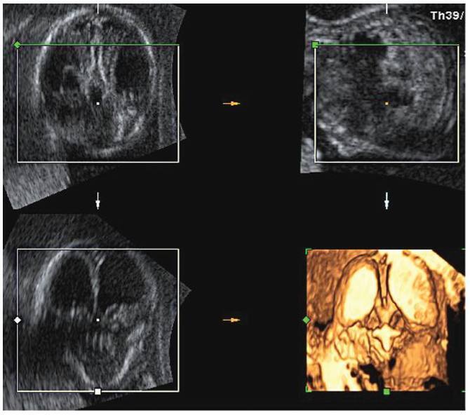Prenatal Diagnosis of Lissencephaly Type 2 using Three-dimensional Ultrasound and Fetal MRI: Case Report and Review of the Literature