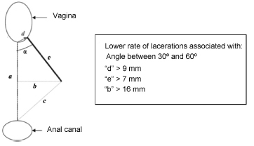 Selective Episiotomy: Indications, Techinique, and Association with Severe Perineal Lacerations