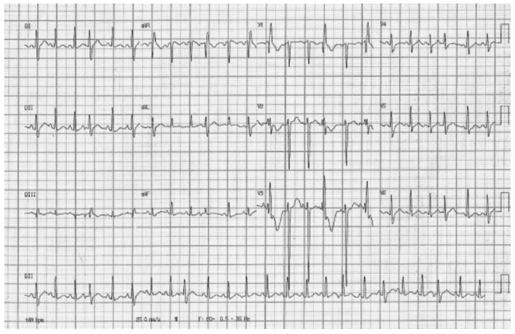 Peripartum Cardiomyopathy Treatment with Dopamine Agonist and Subsequent Pregnancy with a Satisfactory Outcome