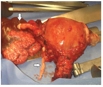 Pelvic Intravenous Leiomyomatosis – Case Report