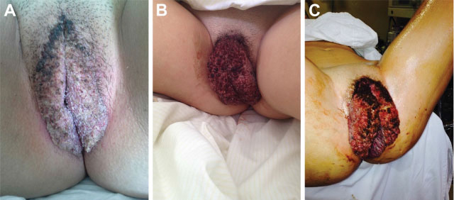 Giant Condyloma (Buschke-Loewenstein Tumor) in a 16-year-old Patient: Case Report