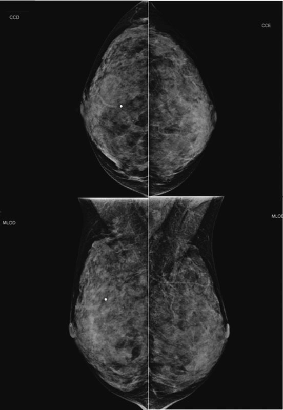 Lobular Carcinoma in Situ with Atypical Mass Presentation: a Case Report