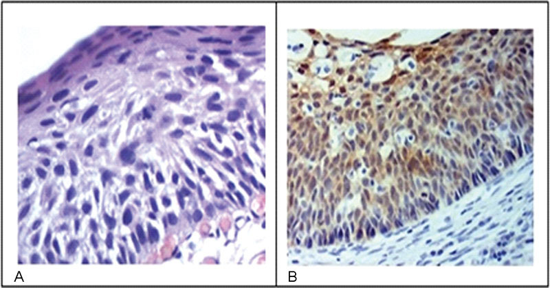 Expression of the Immunohistochemical Markers p16 and Ki-67 and Their Usefulness in the Diagnosis of Cervical Intraepithelial Neoplasms