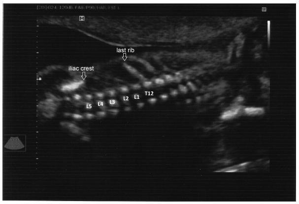 Comparison of Two- and Three-dimensional Ultrasonography in the Evaluation of Lesion Level in Fetuses with Spina Bifida