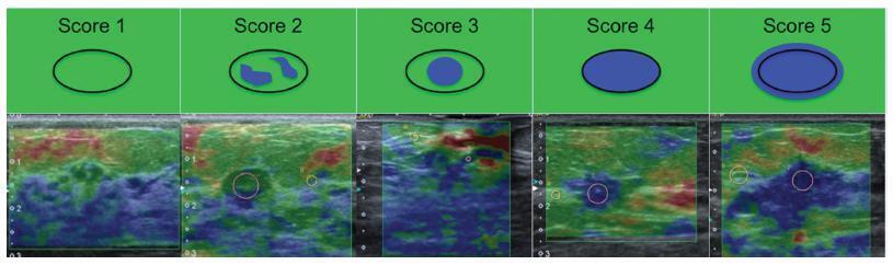 Elastographic Evaluation of Indeterminate Breast Masses on Ultrasound