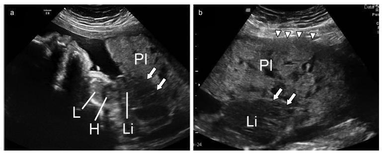 Limb Body Wall Complex Associated with Placenta Accreta: A Mere Coincidence or a Sign of an Etiopathogenic Link?