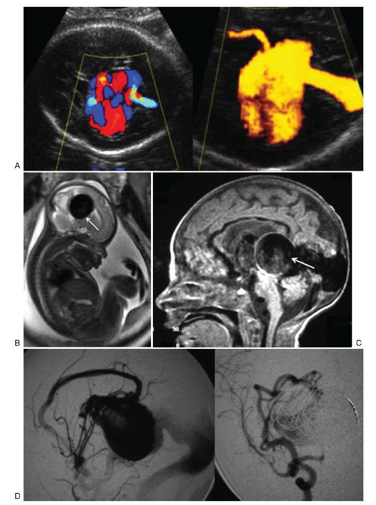 Prenatal Diagnosis of Galen Vein Aneurysm Using Ultrasonography and Magnetic Resonance Imaging and Perinatal and LongTerm Neurological Outcomes: A Case Series