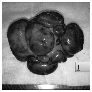 Cotyledonoid Dissecting Leiomyoma with Symplastic Features: Case Report