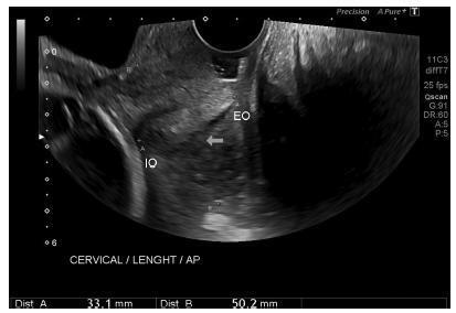 Reference Ranges for Ultrasonographic Measurements of the Uterine Cervix in Low-Risk Pregnant Women