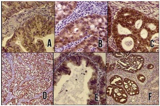 Immunohistochemical Expression of the Tumor Suppressor Protein p16 INK4a in Cervical Adenocarcinoma