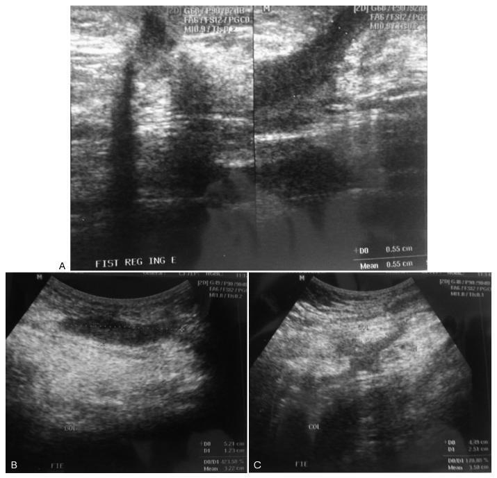 Tubocutaneous Fistula due to Endometriosis – A Differential Diagnosis in Cutaneous Fistulas with Cyclic Secretion