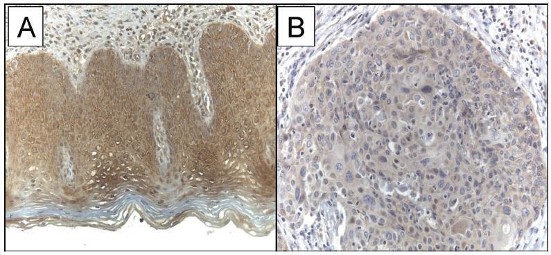 Immunohistochemical WWOX Expression and Association with Angiogenesis, p53 Expression, Cell Proliferation and Clinicopathological Parameters in Cervical Cancer