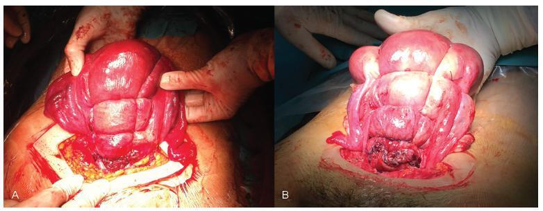 Modified Pereira Suture as an Effective Option to Treat Postpartum Hemorrhage due to Uterine Atony