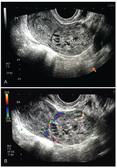 Gestational Trophoblastic Neoplasia after Ectopic Molar Pregnancy: Clinical, Diagnostic, and Therapeutic Aspects