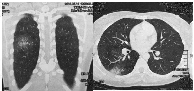 Hemoptysis and Endometriosis: An Unusual Association – Case Report and Review of the Literature