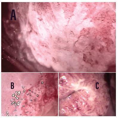 Performance of Conventional Cytology and Colposcopy for the Diagnosis of Cervical Squamous and Glandular Neoplasias