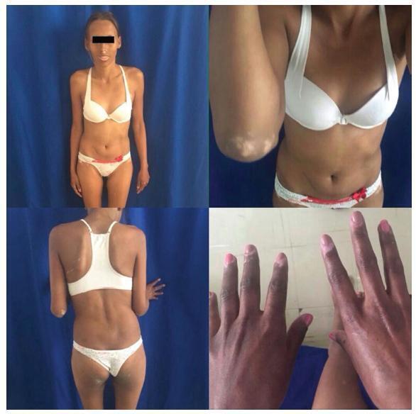 Primary Amenorrhea Associated with Hyperprolactinemia in Polyglandular Autoimmune Syndrome Type II: A Case Report