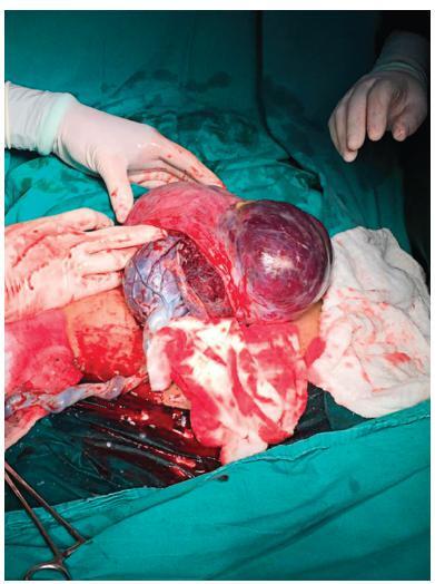 Conservative Surgical Treatment of a Case of Placenta Accreta