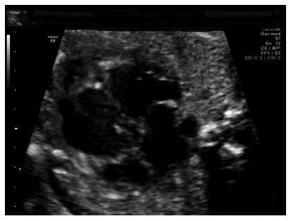 Fetal Noncompaction Cardiomyopathy and Histologic Diagnosis of Spongy Myocardium: Case Report and Review of the Literature