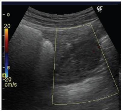 Oophoropexy to the Round Ligament after Recurrent Adnexal Torsion