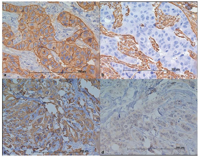 Identification of a Subtype of Poorly Differentiated Invasive Ductal Carcinoma of the Breast Based on Vimentin and E-cadherin Expression