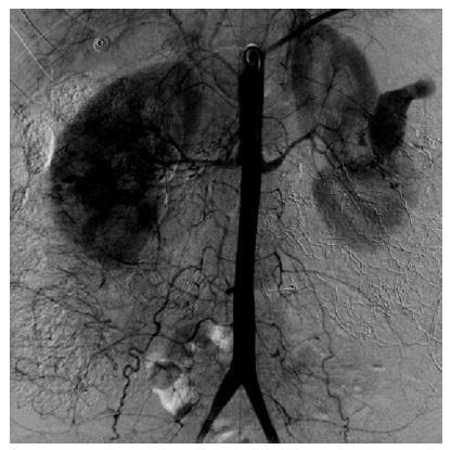 Ruptured Renal Artery Aneurysm in a Pregnant Woman: Case Report and Literature Review