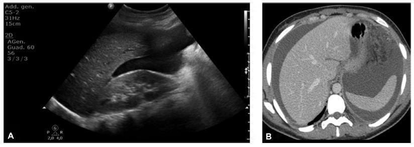 Imaging Description of Extragenital Müllerian Adenosarcoma: A Case Report