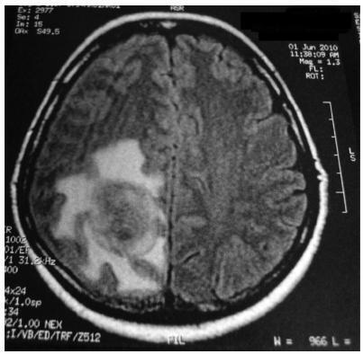 Brain Metastasis in Papillary Serous Adenocarcinoma of the Endometrium