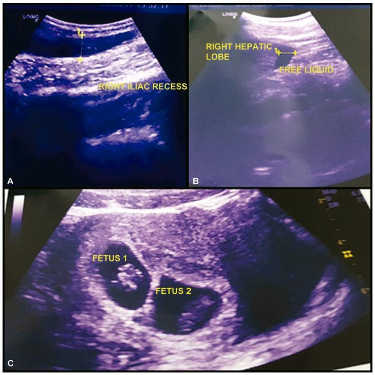Spontaneous Heterotopic Triplet Pregnancy with a Two Viable Intrauterine Embryos and an Ectopic One with Right Tubal Rupture