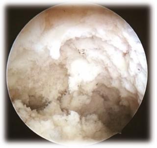 Endometrial Tuberculosis: Hysteroscopic Findings of a Clinical Case