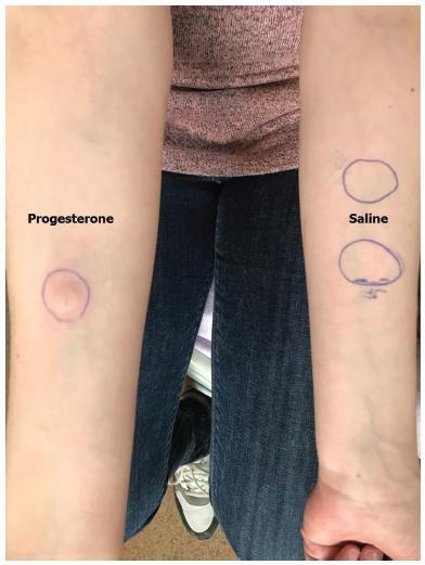 Autoimmune Progesterone Dermatitis: A Case Report