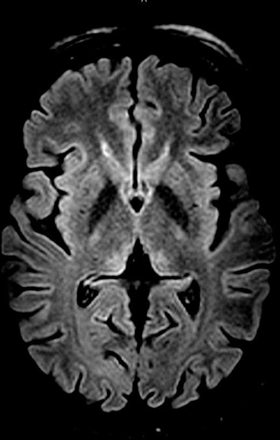 Wernicke Encephalopathy as a Complication of Hyperemesis Gravidarum: Case Report