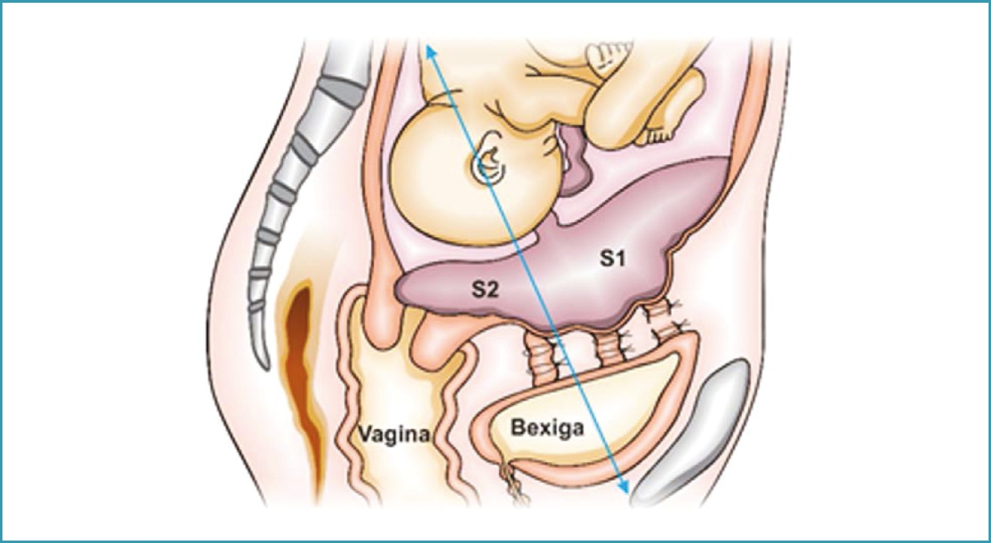 Surgical management of postpartum hemorrhage Number 4 – October 2020