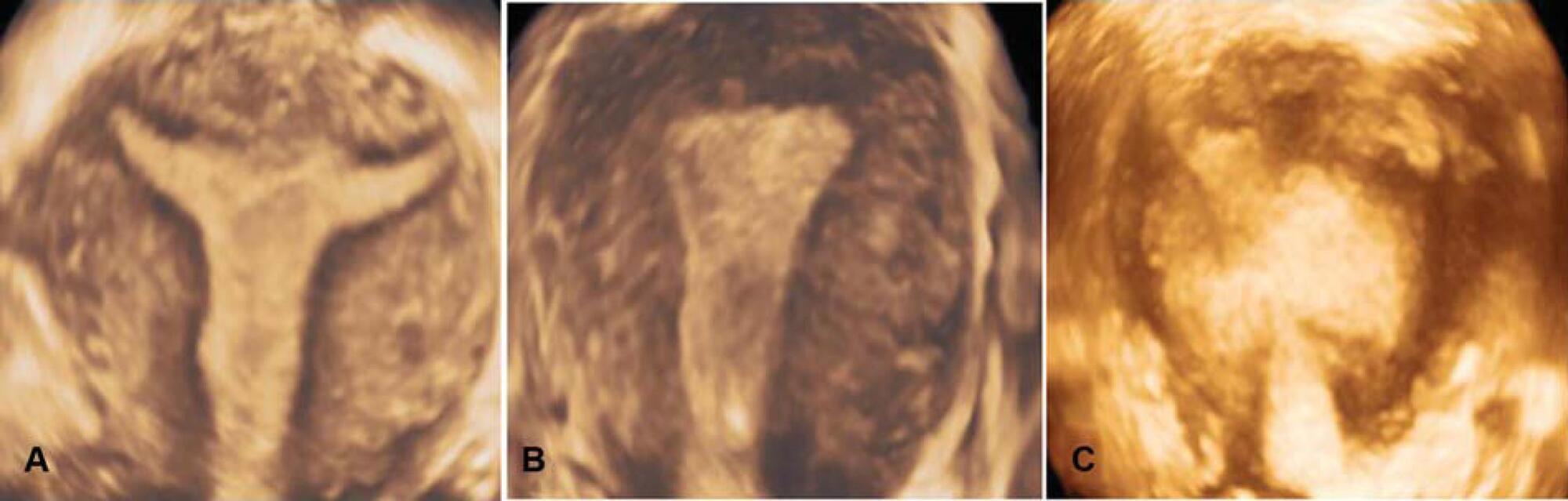 Junctional Zone in Infertile Women: A Three-dimensional Ultrasound Study