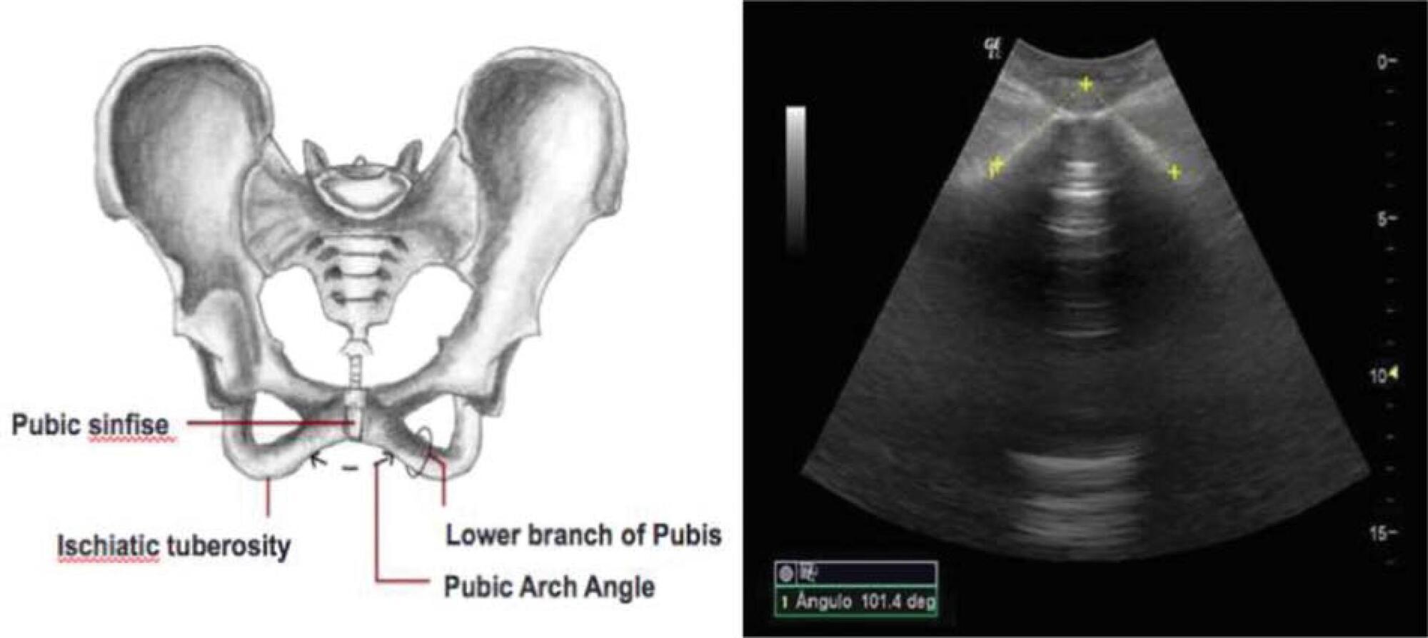 Pubic Arch Angle Measurement by Transperineal Ultrasonography: A Prospective Cross-Sectional Study