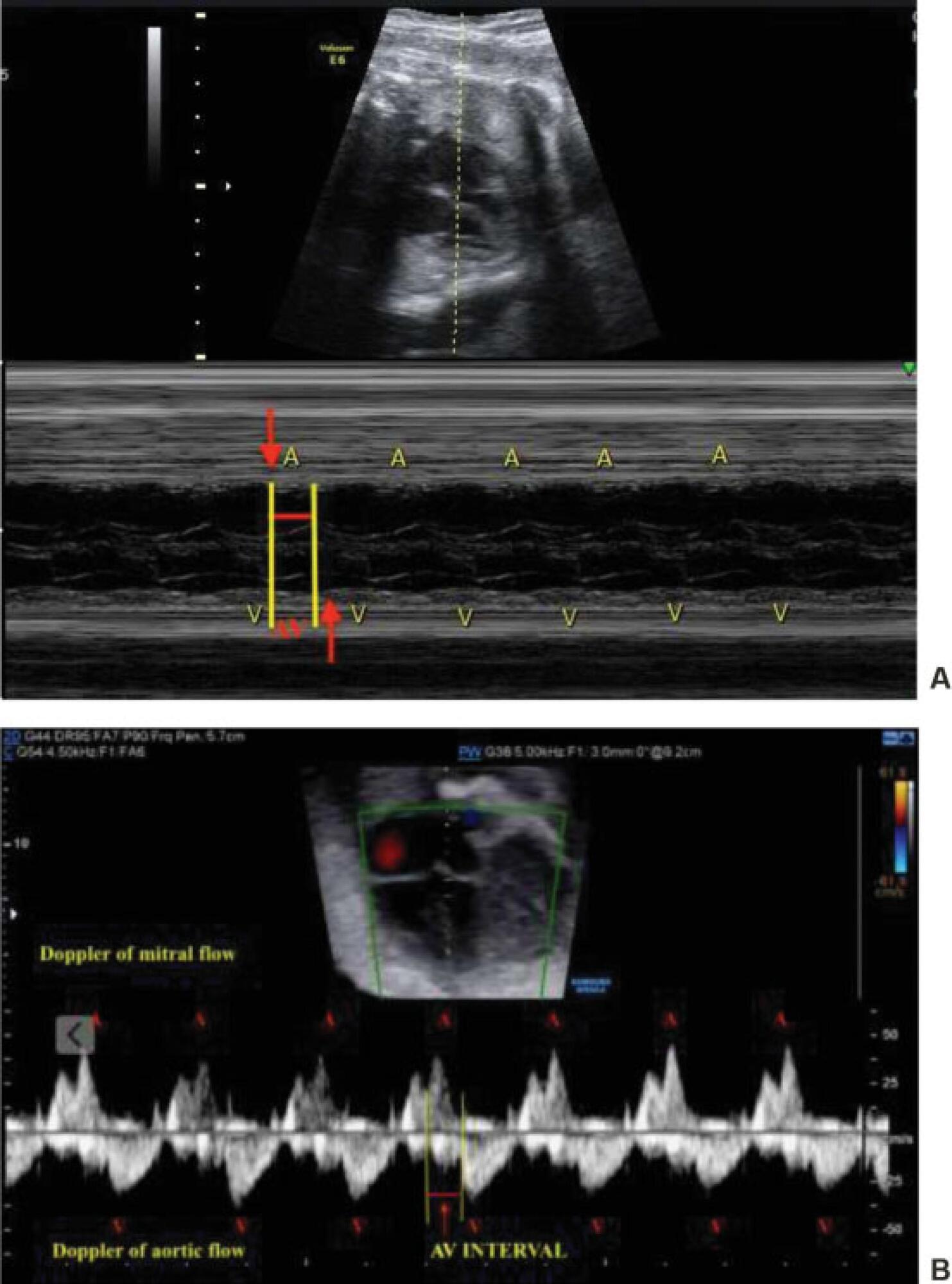 Congenital Complete Atrioventricular Heart Block in a Pregnant Woman with Sjögren Syndrome: Prenatal Care Follow-Up and the Challenge of Intrauterine Treatment