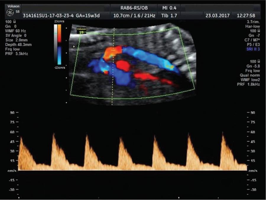 Aortic Isthmus Doppler Velocimetry in Fetuses with Intrauterine Growth Restriction: A Literature Review