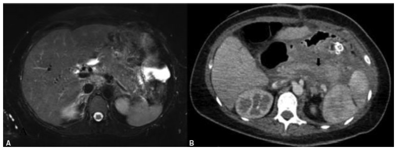 Familial Chylomicronemia Syndrome-Induced Acute Necrotizing Pancreatitis during Pregnancy