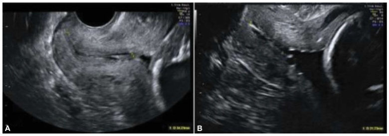 The Impact of Routine Transvaginal Ultrasound Measurement of the Cervical Length on the Prediction of Preterm Birth: A Retrospective Study in a Tertiary Hospital
