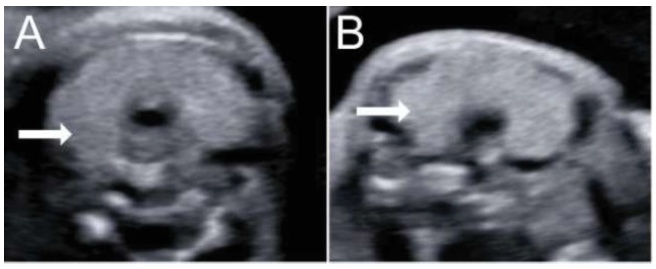 Excessive Prenatal Supplementation of Iodine and Fetal Goiter: Report of Two Cases Using Three-dimensional Ultrasound and Magnetic Resonance Imaging