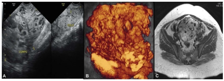 Uterine Rescue in High-Risk Gestational Trophoblastic Neoplasia Treated with EMA-CO by Uterine Arteries Embolization due to Arteriovenous Malformations