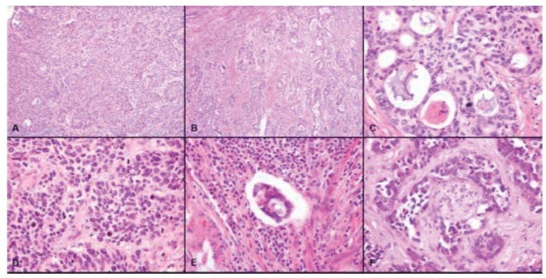 Cervical Mesonephric Adenocarcinoma: A Case Report of a Rare Gynecological Tumor from Embryological Remains of the Female Genital Tract