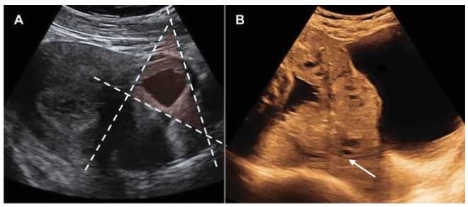 Placenta Accreta Spectrum Disorders and Cesarean Scar Pregnancy Screening: Are we Asking the Right Questions?
