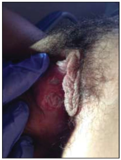 Lipschütz Ulcer: An Unusual Diagnosis that Should Not be Neglected