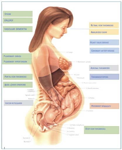 Obstetric antiphospholipid syndrome – Number 6 – June 2021