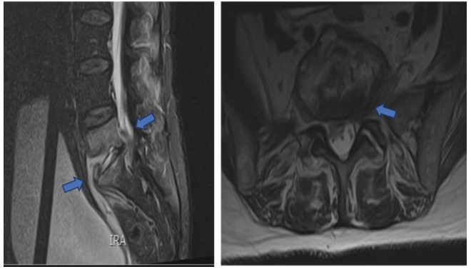 Conservative Management of Spondylodiscitis after Laparoscopic Sacral Colpopexy: A Case Report and Review of Literature