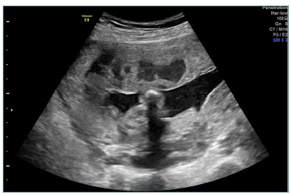 Management of placenta accreta spectrum Number 9 – September 2021