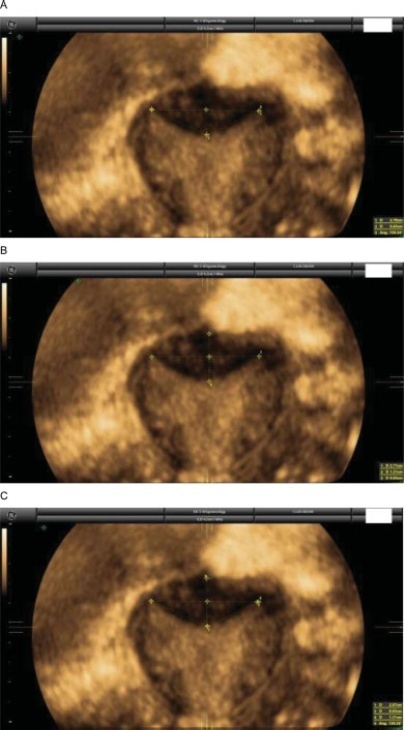 Diagnosing Septate Uterus Using Three-Dimensional Ultrasound Using Three Different Classifications: An Interobserver and Intraobserver Agreement Study