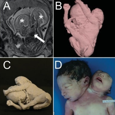 Antenatal Diagnosis of Parapagus Conjoined Twins: 3D Virtual and 3D Physical Models
